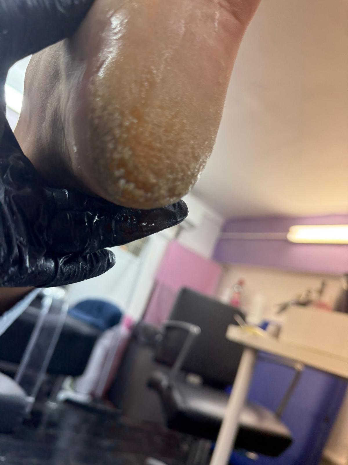 פדיקור רפואי לפני ואחרי